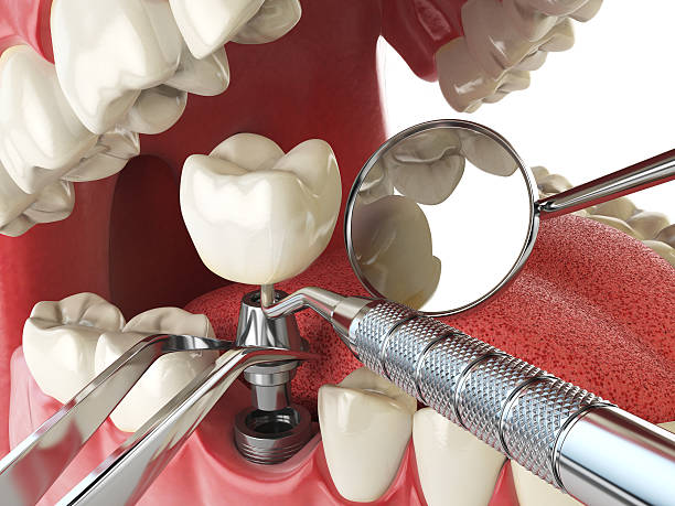 Best Emergency Dentist for Lost Fillings or Crowns in Lofall, WA